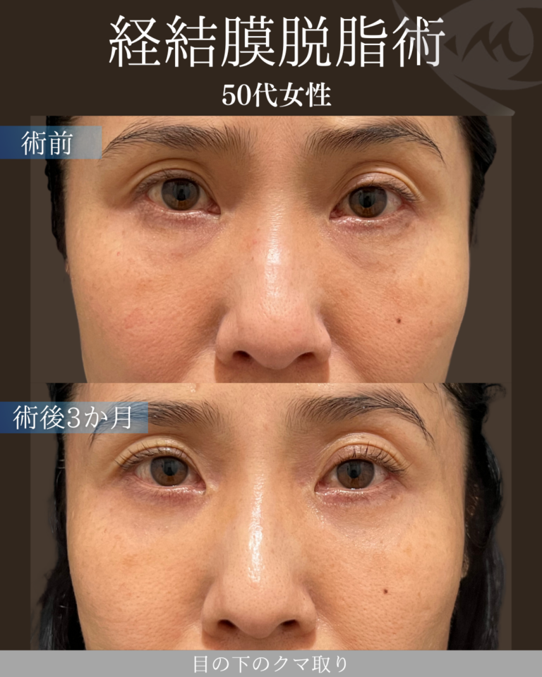 50代女性 経結膜脱脂術  術後3ヶ月